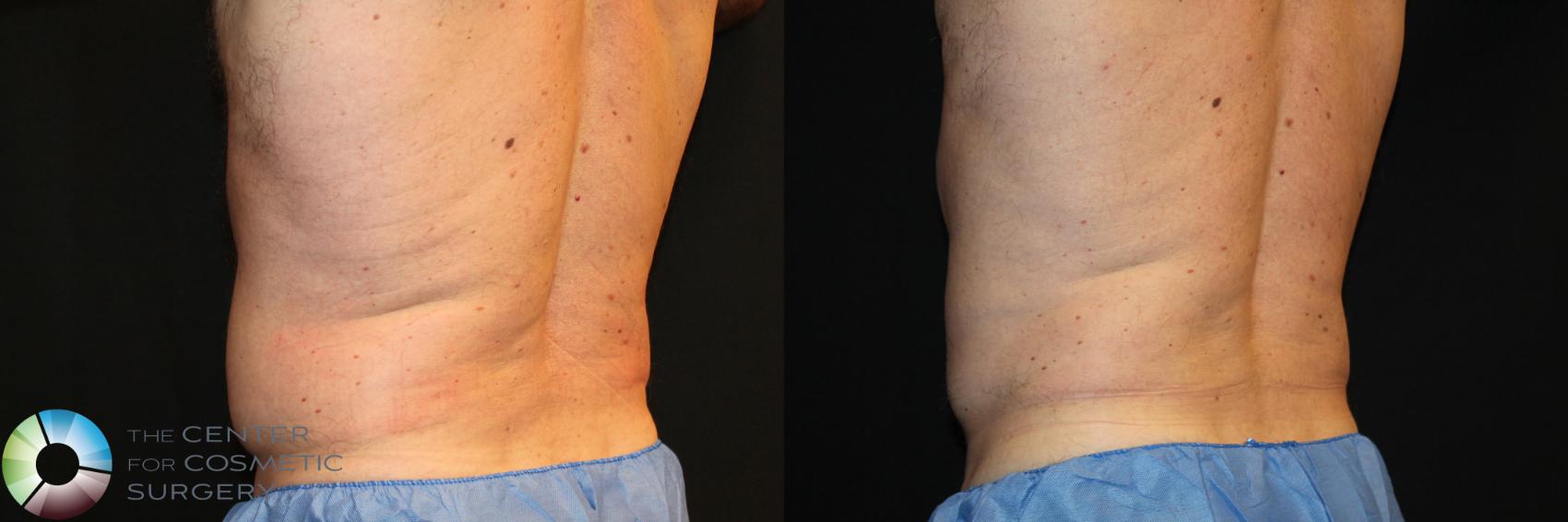 Before & After CoolSculpting Case 746 View #1 in Denver and Colorado Springs, CO