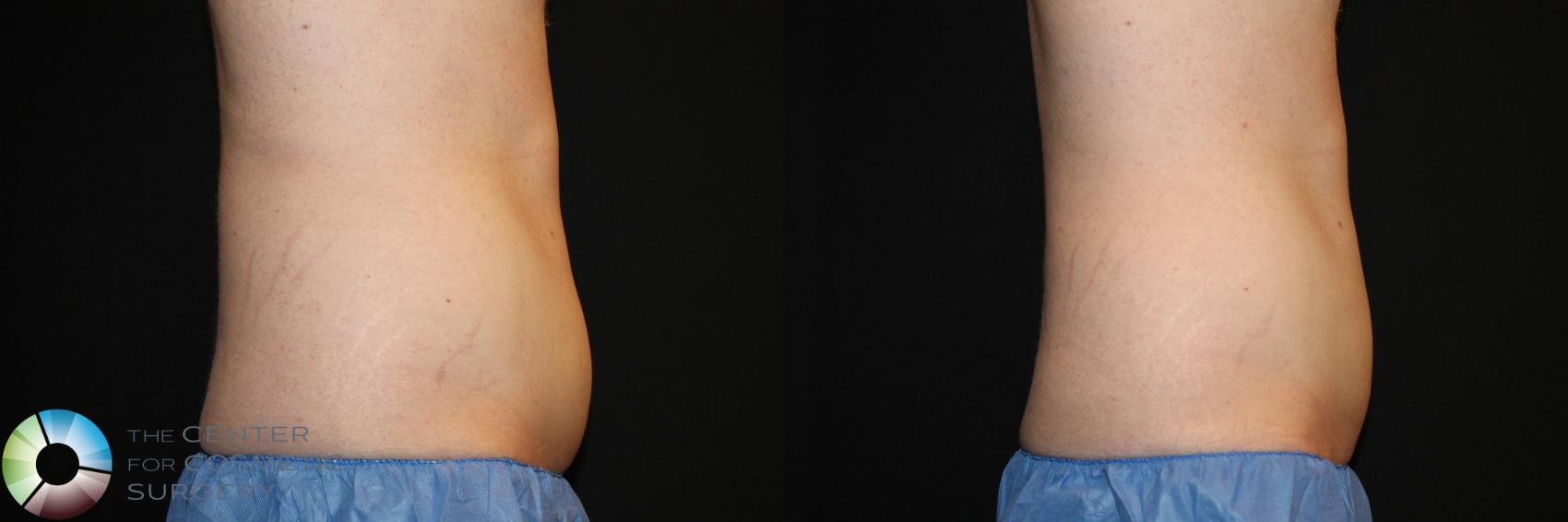 Before & After CoolSculpting Case 747 View #1 in Denver and Colorado Springs, CO