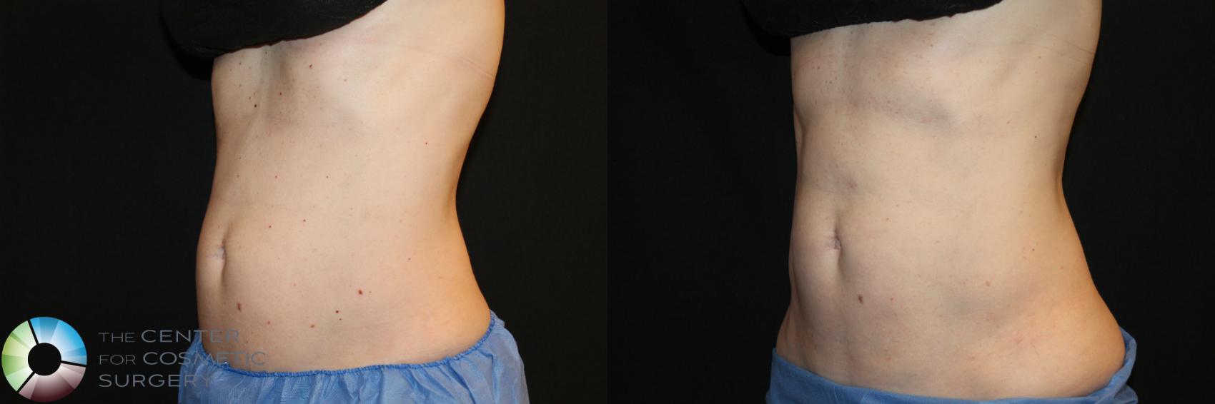 Before & After CoolSculpting Case 752 View #1 in Denver and Colorado Springs, CO