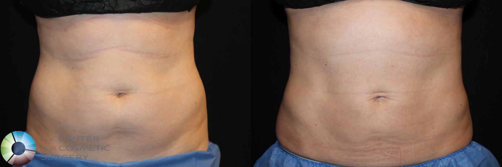 Before & After CoolSculpting Case 764 View #1 in Denver and Colorado Springs, CO