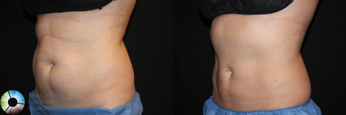 Before & After CoolSculpting Case 764 View #2 View in Golden, CO