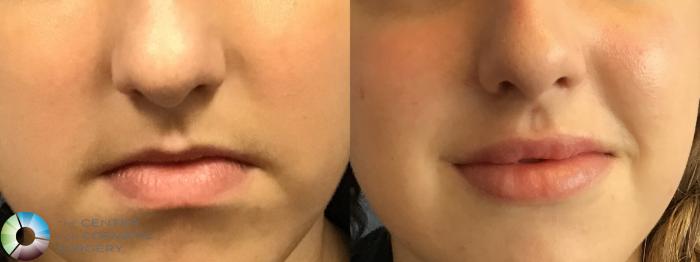 Before & After Dermal Fillers Case 11260 Front View in Golden, CO
