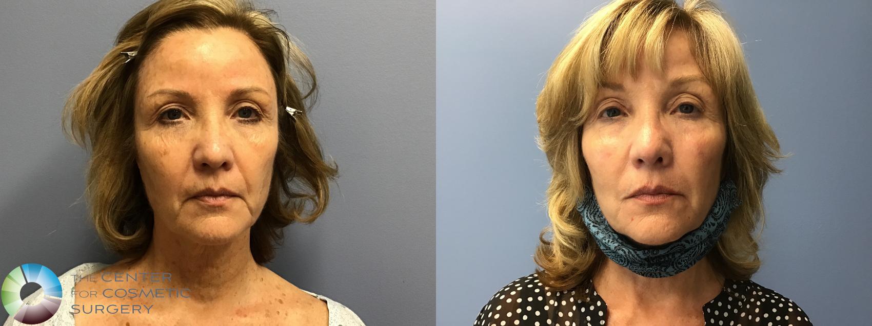 Before & After Dermal Fillers Case 11585 Front View in Golden, CO