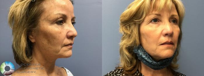 Before & After Dermal Fillers Case 11585 Right Oblique View in Golden, CO