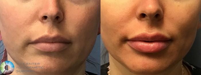 Before & After Dermal Fillers Case 11587 Front View in Golden, CO
