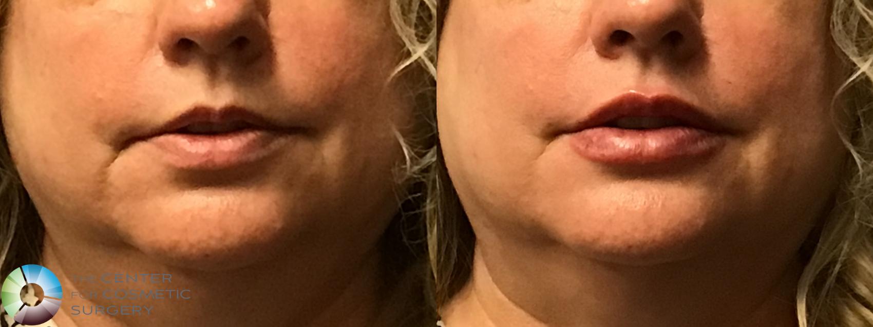 Before & After Dermal Fillers Case 11588 Front in Denver and Colorado Springs, CO