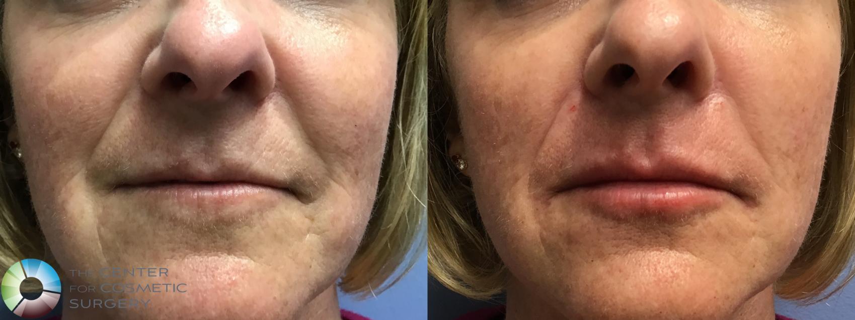 Before & After Dermal Fillers Case 11589 Front View in Golden, CO