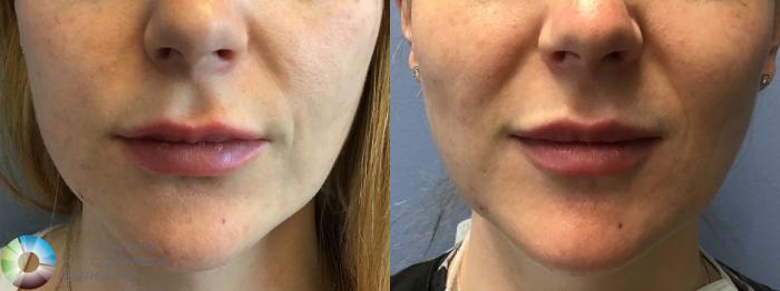 Before & After Dermal Fillers Case 11591 Front View in Golden, CO