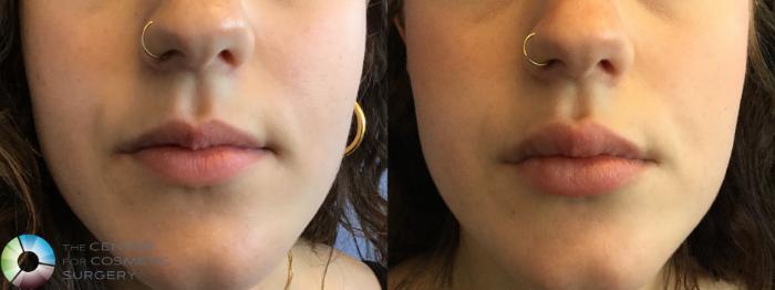 Before & After Dermal Fillers Case 11592 Front View in Golden, CO