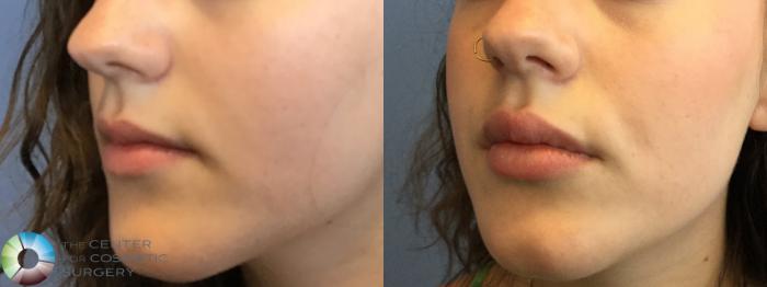 Before & After Dermal Fillers Case 11592 Left Oblique View in Golden, CO