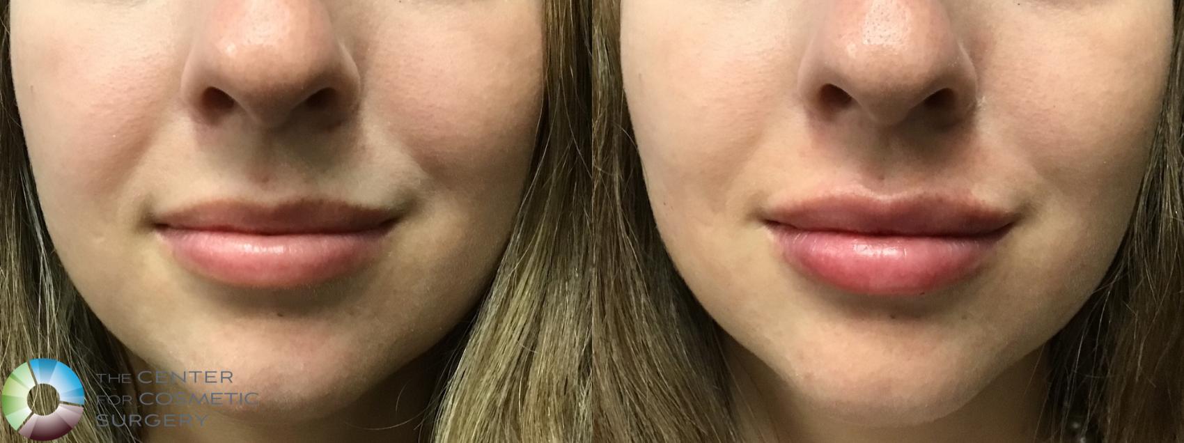 Before & After Dermal Fillers Case 11593 Front View in Golden, CO