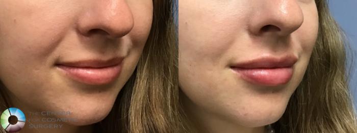 Before & After Dermal Fillers Case 11593 Right Oblique View in Golden, CO