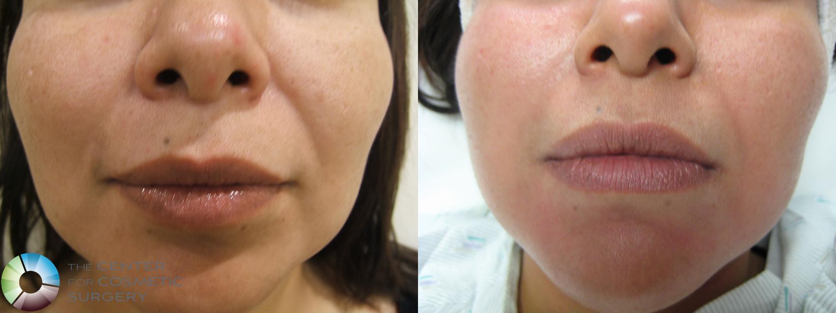 Before & After Dermal Fillers Case 282 View #1 in Denver, CO