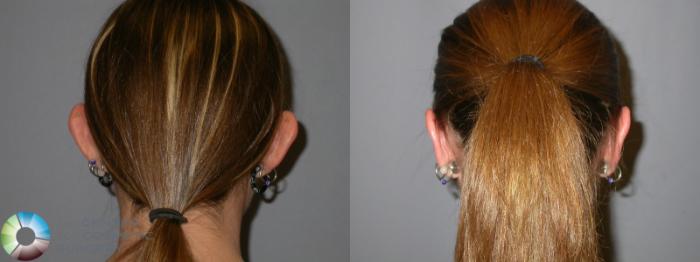 Before & After Ear Surgery Case 108 View #4 in Denver, CO