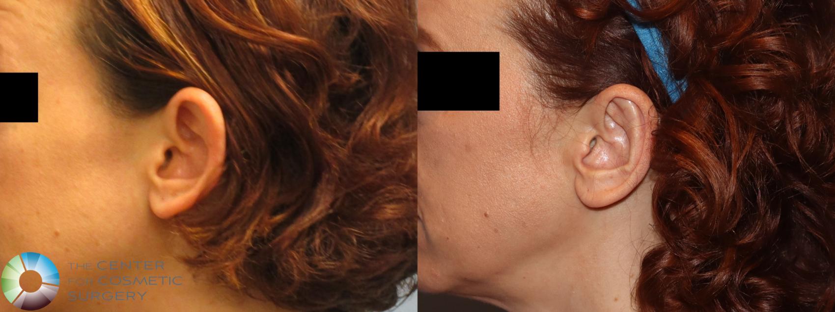 Best Denver Ear Surgery Otoplasty