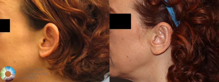Before & After Ear Surgery Case 11759 Left Side View in Golden, CO