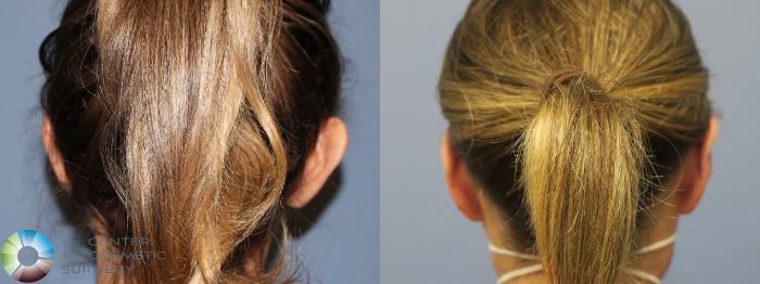 Before & After Ear Surgery Case 11760 Back View in Golden, CO