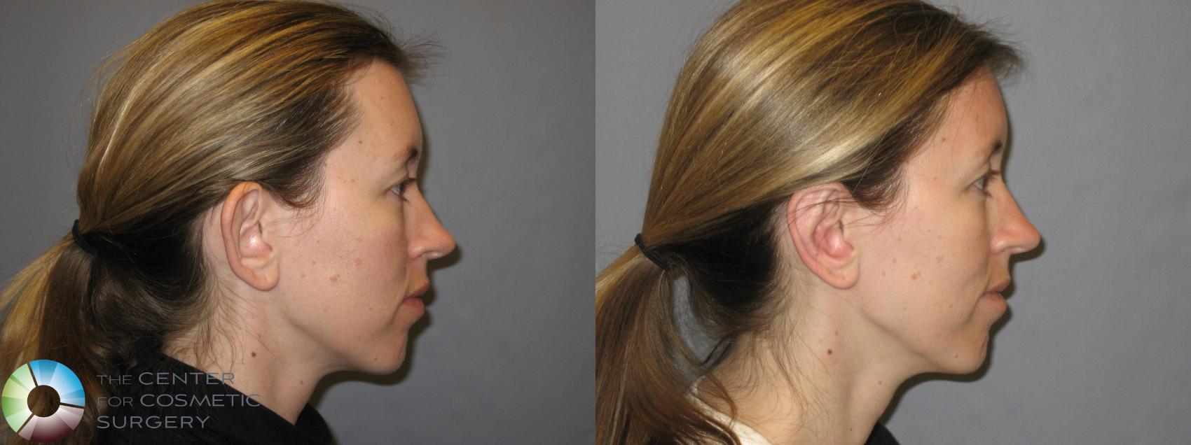 Before & After Ear Surgery Case 259 View #2 View in Denver & Golden, CO