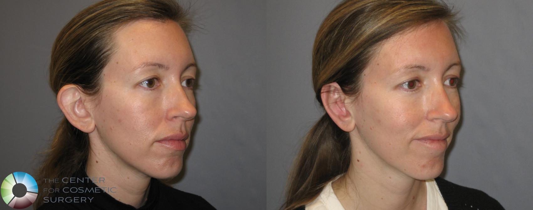 Before & After Ear Surgery Case 259 View #3 View in Denver & Golden, CO