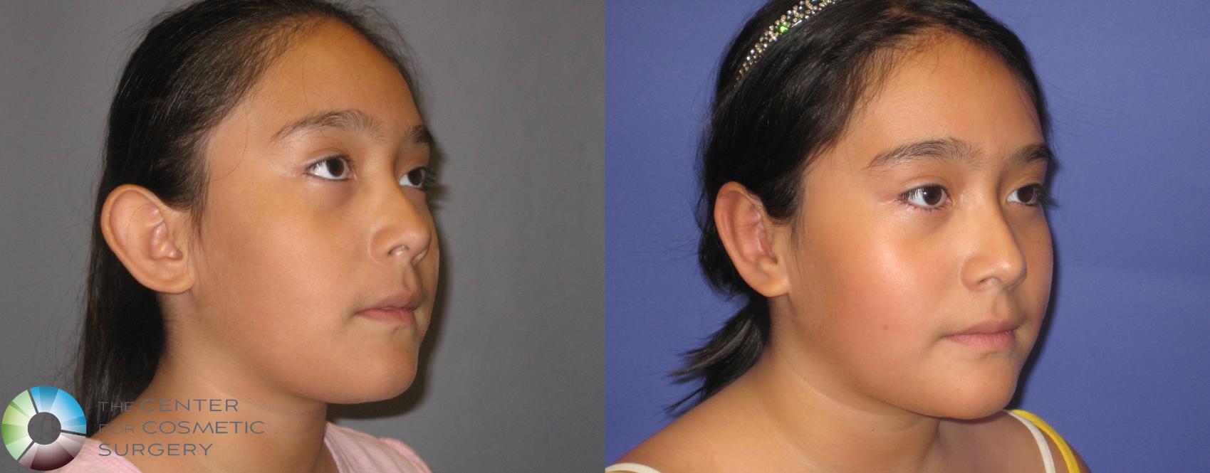 Before & After Ear Surgery Case 340 View #2 View in Denver & Golden, CO