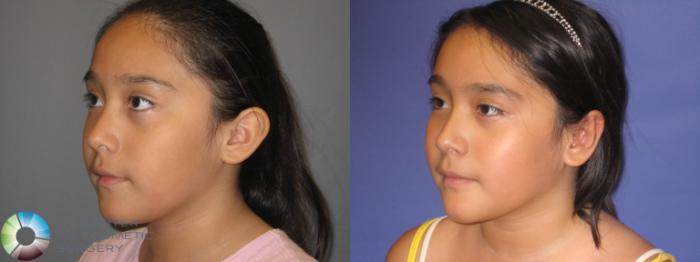 Before & After Ear Surgery Case 340 View #3 View in Golden, CO