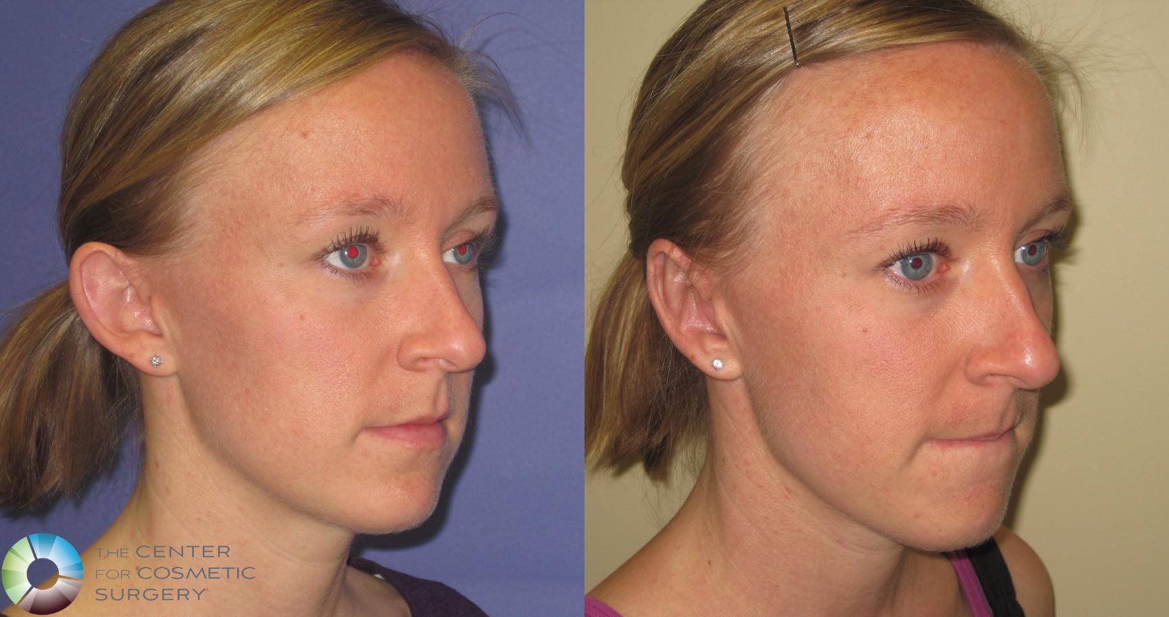 Before & After Ear Surgery Case 416 View #2 in Denver and Colorado Springs, CO