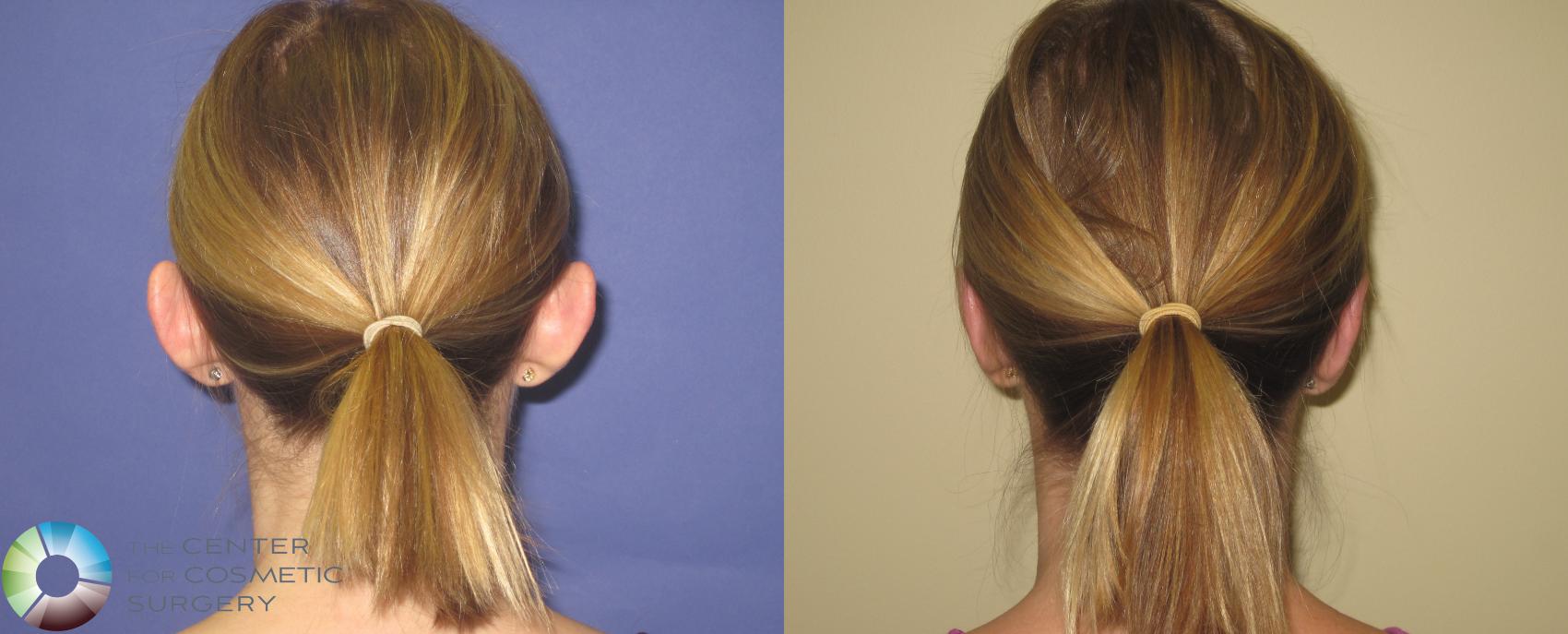 Before & After Ear Surgery Case 416 View #4 View in Denver & Golden, CO