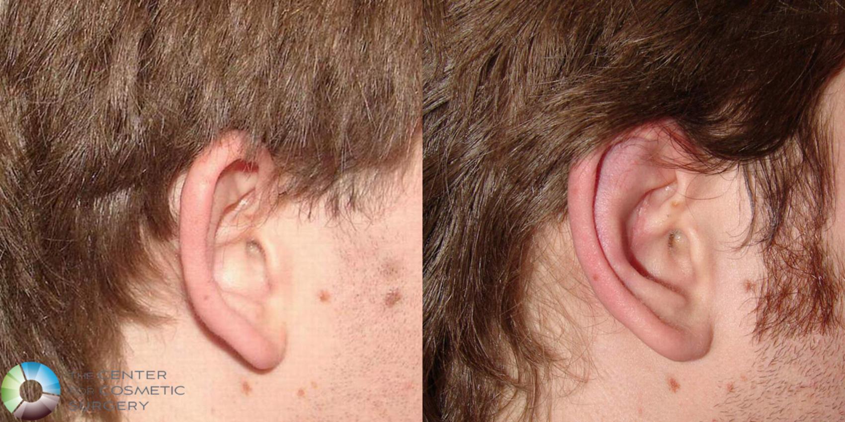Before & After Ear Surgery Case 502 View #2 in Denver and Colorado Springs, CO