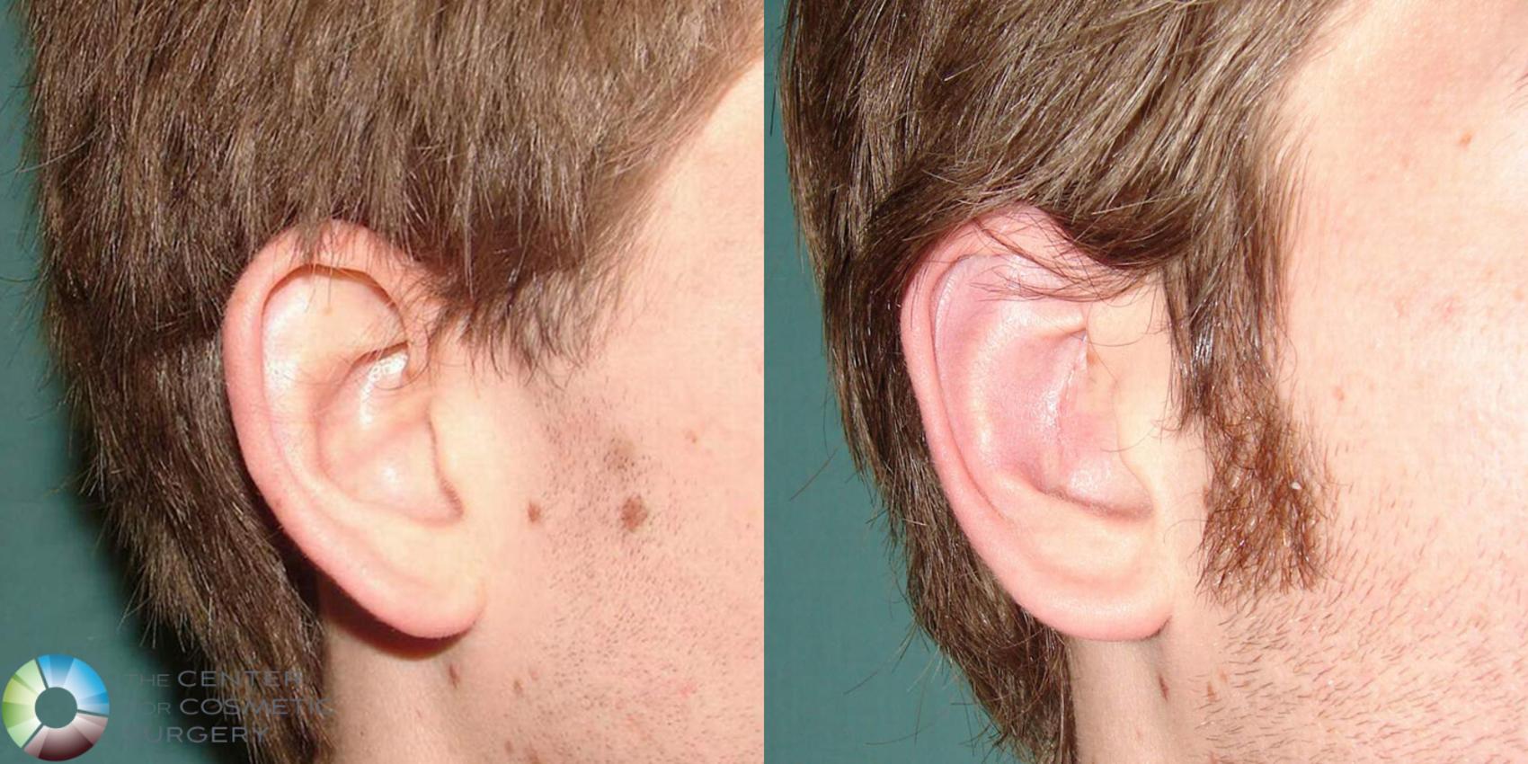 Before & After Ear Surgery Case 502 View #3 in Denver and Colorado Springs, CO