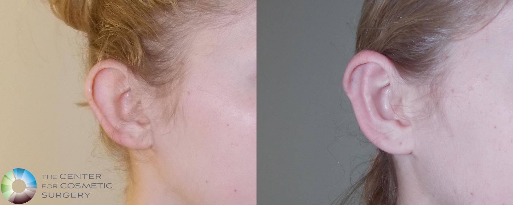 Before & After Ear Surgery Case 684 View #2 View in Denver & Golden, CO