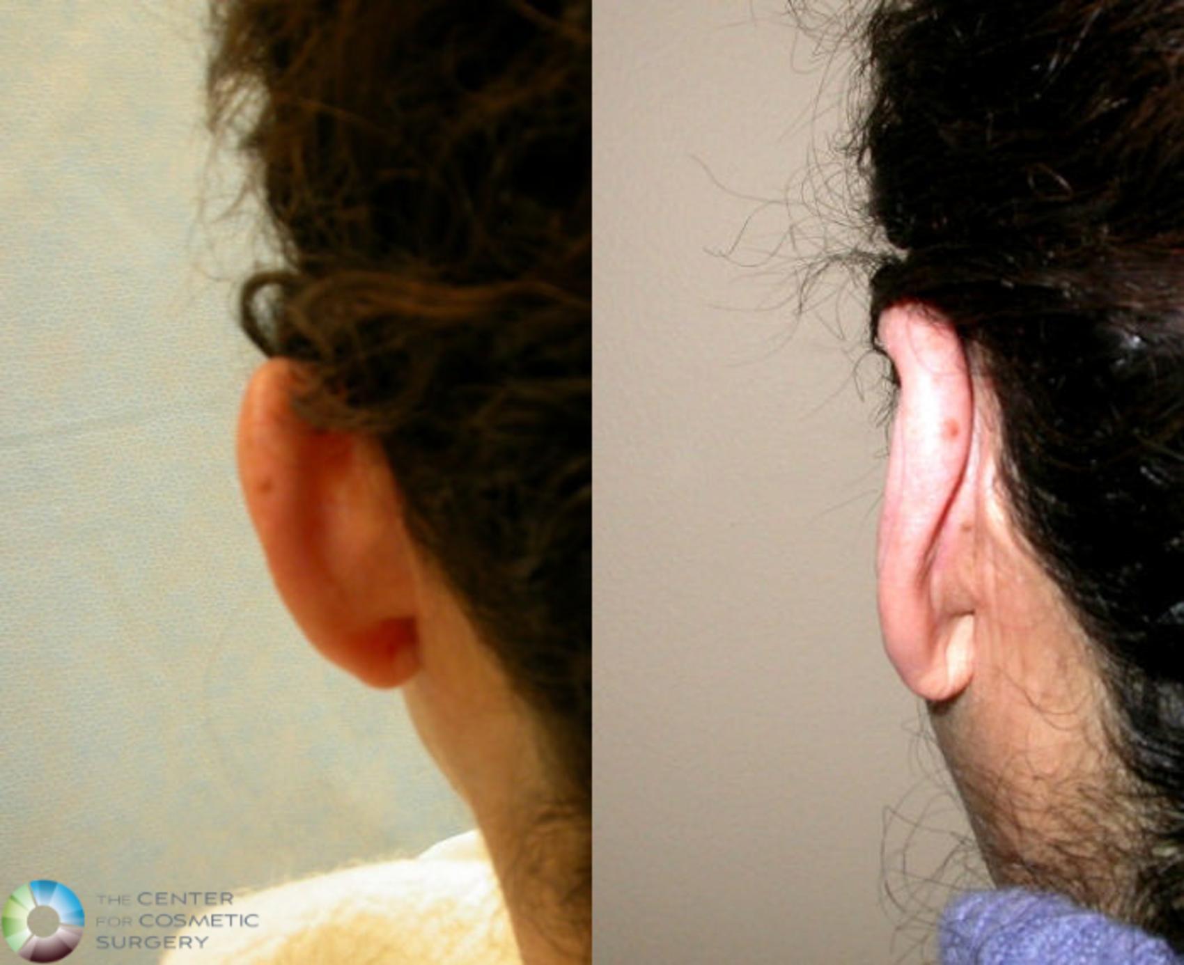 Before & After Ear Surgery Case 69 View #2 View in Denver & Golden, CO