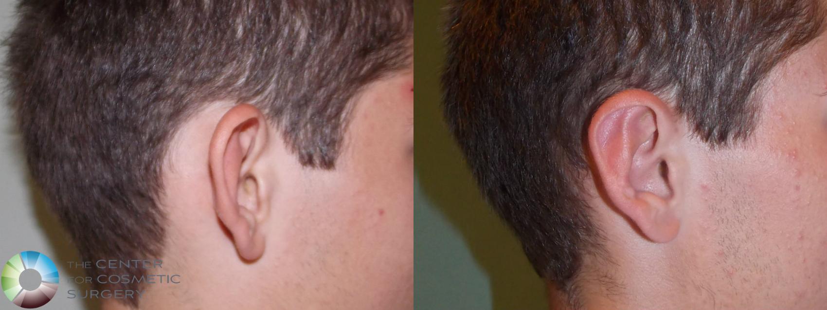 Before & After Ear Surgery Case 732 View #3 View in Denver & Golden, CO