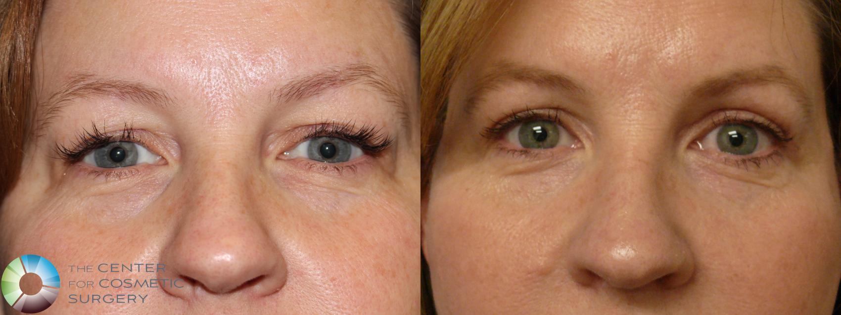 upper blepharoplasty gone wrong