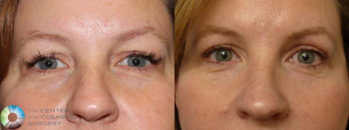 Before & After Eyelid Lift Case 11365 Front in Denver and Colorado Springs, CO
