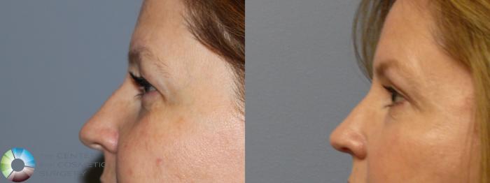 Before & After Eyelid Lift Case 11365 Left Side in Denver and Colorado Springs, CO