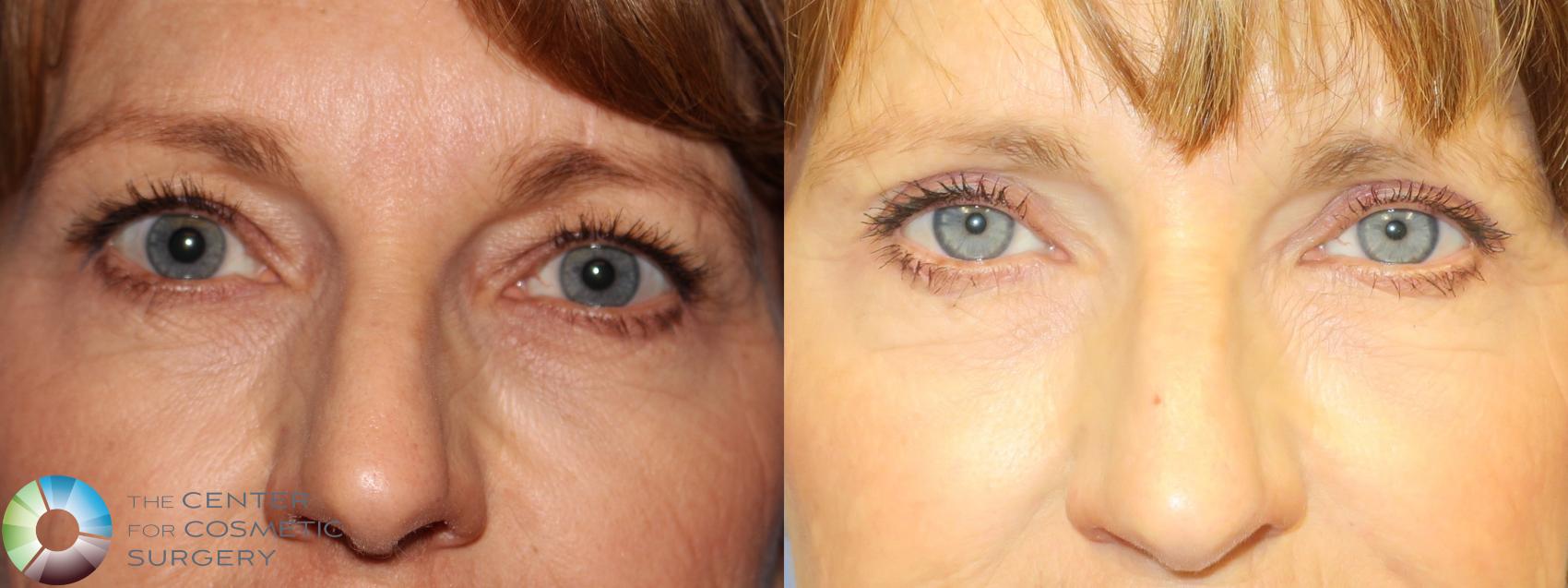 Before & After Eyelid Lift Case 11368 Front in Denver and Colorado Springs, CO