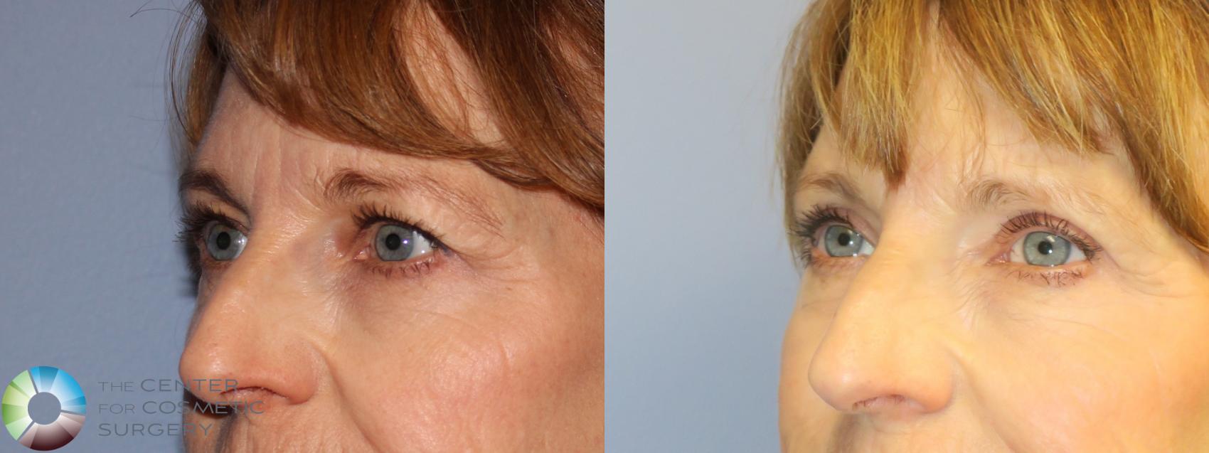Before & After Eyelid Lift Case 11368 Left Oblique in Denver and Colorado Springs, CO