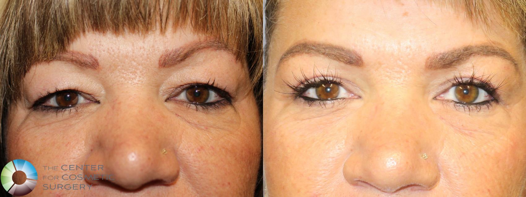 Before & After Eyelid Lift Case 11369 Front in Denver and Colorado Springs, CO