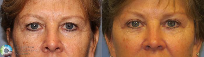 Before & After Eyelid Lift Case 11486 brow eyes front View in Golden, CO