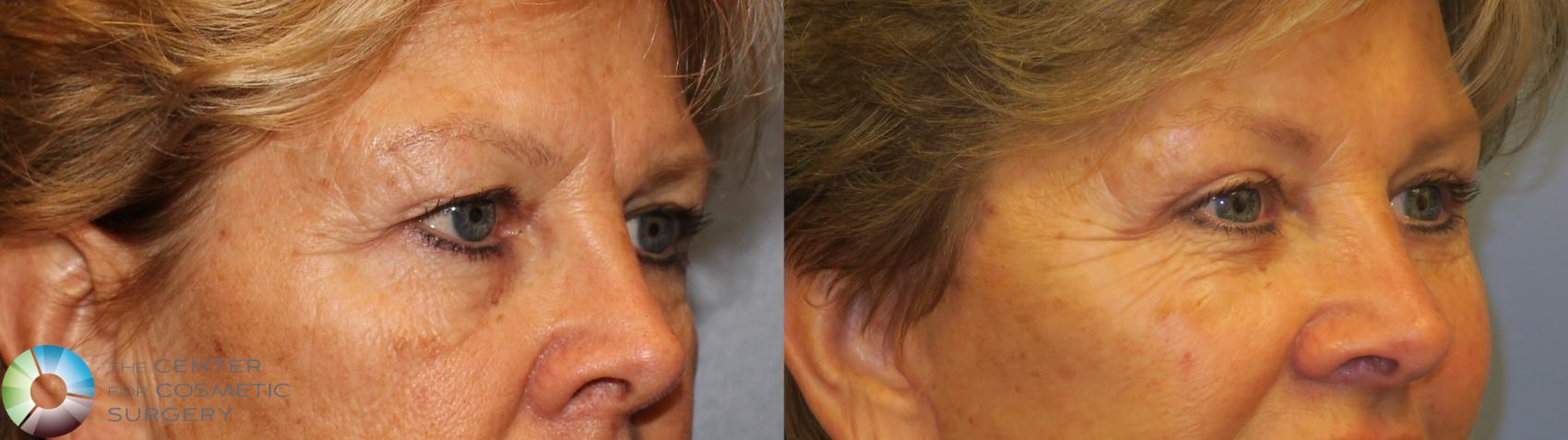 Before & After Eyelid Lift Case 11486 brow eyes oblique View in Denver & Golden, CO