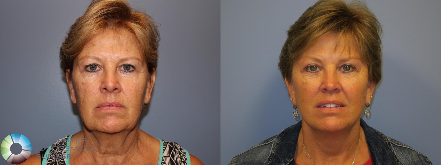 Before & After Eyelid Lift Case 11486 Front View in Golden, CO