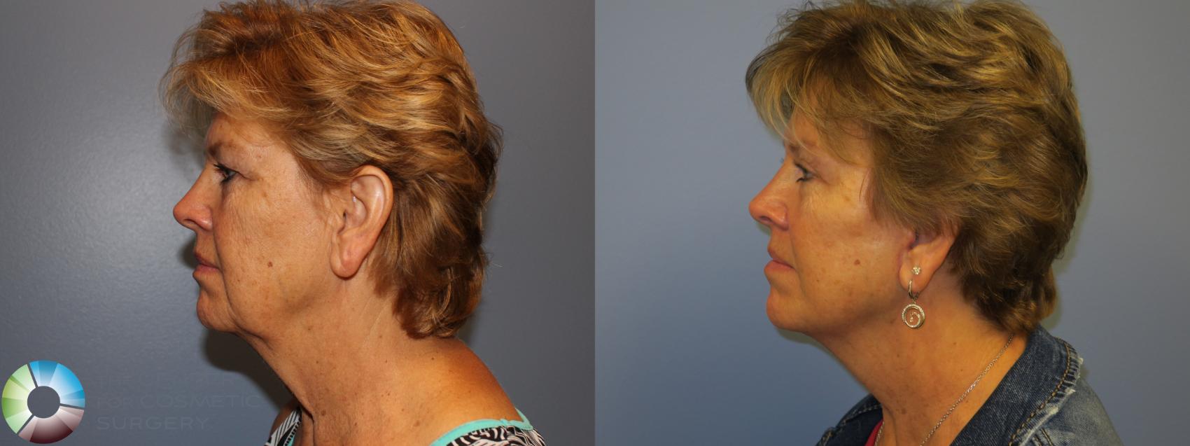 Before & After Eyelid Lift Case 11486 Left Side View in Golden, CO