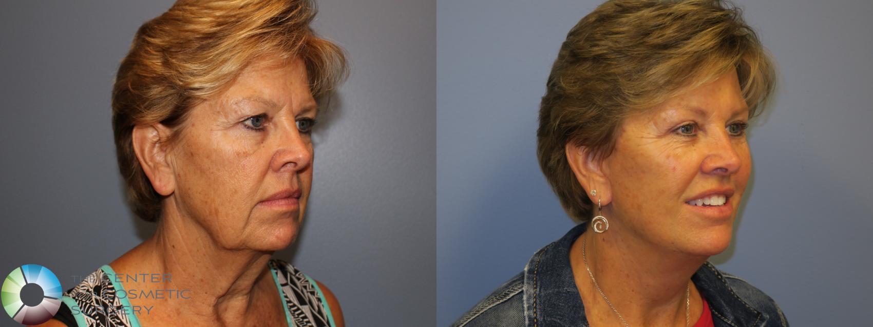 Before & After Eyelid Lift Case 11486 Right Oblique View in Denver & Golden, CO