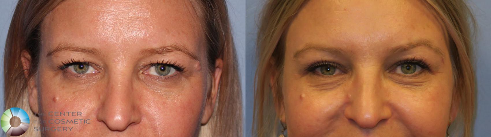 Before & After Eyelid Lift Case 11488 brow eyes front View in Golden, CO