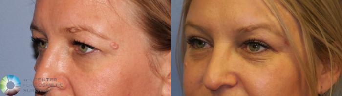 Before & After Eyelid Lift Case 11488 brow eyes left oblique View in Golden, CO