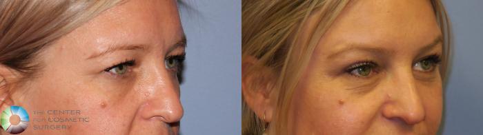 Before & After Eyelid Lift Case 11488 brow eyes oblique View in Golden, CO