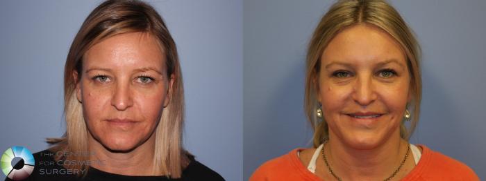 Before & After Eyelid Lift Case 11488 Front View in Golden, CO