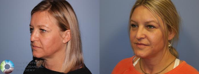 Before & After Mini Brow Lift Case 11488 Left Oblique View in Golden, CO