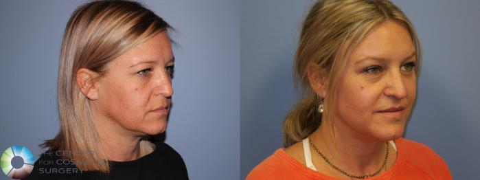 Before & After Mini Brow Lift Case 11488 Right Oblique View in Golden, CO