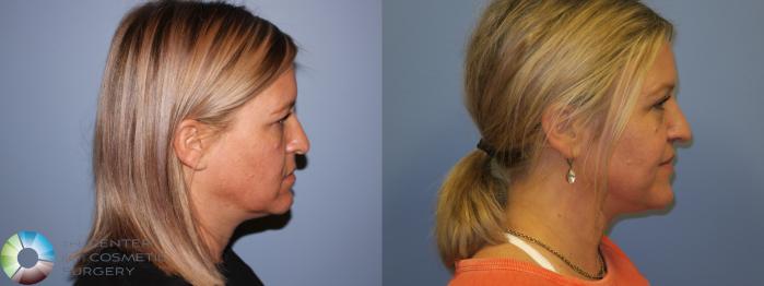 Before & After Eyelid Lift Case 11488 Right Side View in Golden, CO